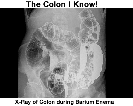 Barium colon image